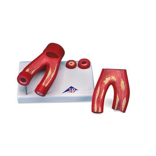 Modello di arteriosclerosi, con sezione delle arterie (in 2 parti)